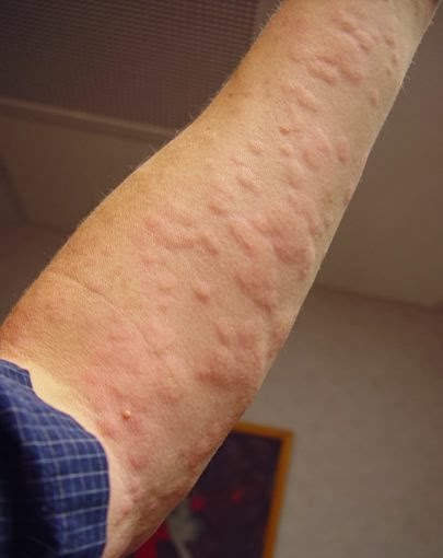 Hives: Characteristic and Causes